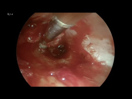 Tympanoplastie de Révision Endoscopique