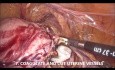 Technique de Goel de Hystérectomie Laparoscopique pour le Cancer de l'Endomètre
