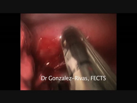 Tumeur Carcinoïde du Poumon - Segmentectomie par Vidéo-Thoracoscopie Uniportale