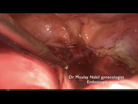 Comment Contourner les Règles de la Myomectomie d'une Manière Sûre