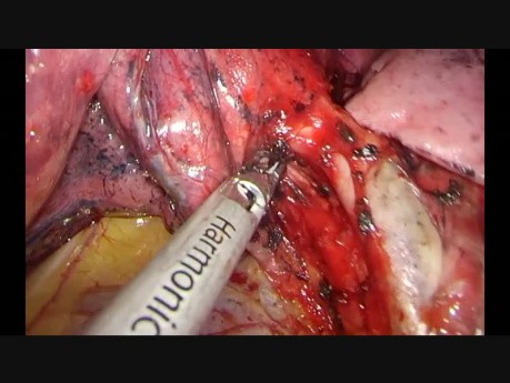 Lobectomie supérieure gauche, la chirurgie thoracique vidéo-assistée (CTVA) en utilisant un seul port uniportale (CTVA-U)