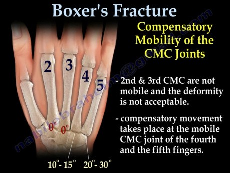 Fracture du boxeur