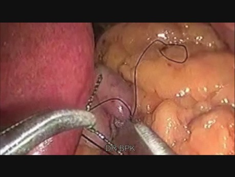 Mini bypass gastrique laparoscipique
