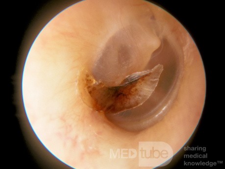 Croûte de membrane tympanique après une otite moyenne aiguë