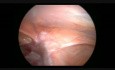 Dispositif intra-utérin dans l'epiploon - laparoscopie diiagnostique