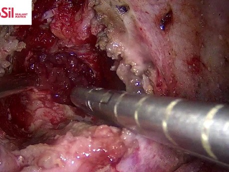 TachoSil pour Soutenir l'Etanchéité de la Dure-Mère en Chirurgie du Rachis