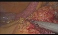 Résection cœlioscopique de l'intestin grêle et du mésentère pour l'adénocarcinome