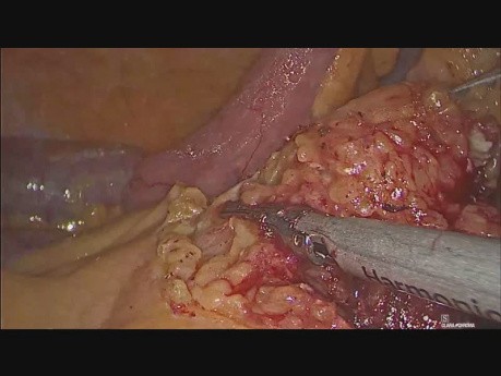 Résection cœlioscopique de l'intestin grêle et du mésentère pour l'adénocarcinome