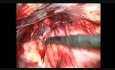 Traitement de la hernie inguinale par coelioscopie. Étape 5: dissection à gauche
