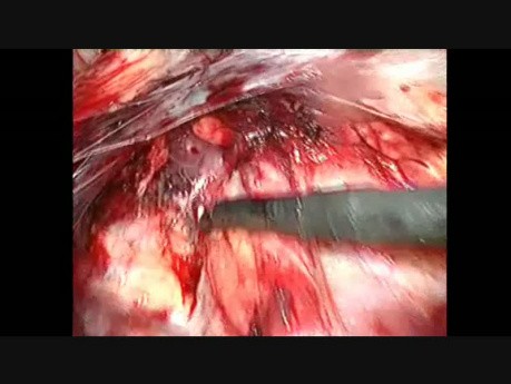 Traitement de la hernie inguinale par coelioscopie. Étape 5: dissection à gauche