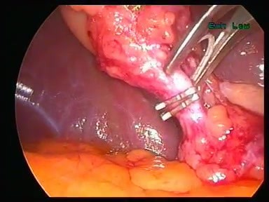 Cholecystectomie sous coelioscopie