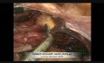 Hystérectomie laparoscopique