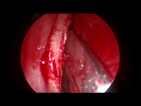 Septoplastie Endoscopique - Série 4