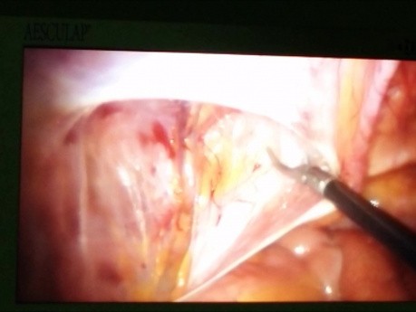 Cure de hernie inguinale par voie laparoscopique trans-abdominale pré-péritonéale