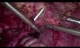 Réimplantation urétéro-vésicale laparoscopique
