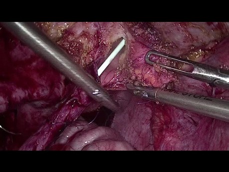 Réimplantation urétéro-vésicale laparoscopique