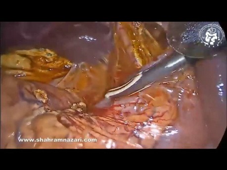 Exploration Laparoscopique des Voies Biliaires Principales et Cholédochoduodénostomie