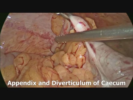 Diverticulectomie caecale par voie laparoscopique