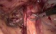 Méthode transabdominale pré-péritonéale (TAPP) de traitement chirurgical de la hernie