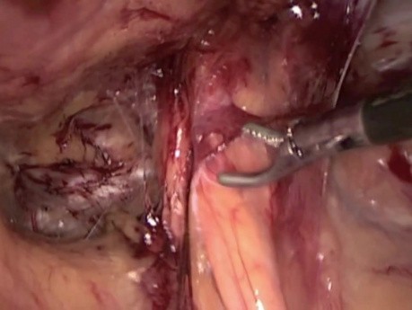 Méthode transabdominale pré-péritonéale (TAPP) de traitement chirurgical de la hernie