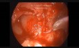 Tympanomastiodectomie endoscopique