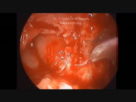 Tympanomastiodectomie endoscopique