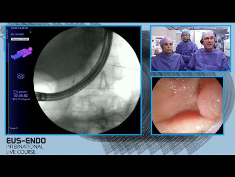 La cholangiopancréatographie rétrograde endoscopique (CPRE) - sphinctérotomie et extraction des calculs du canal pancréatique