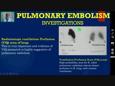 Emboie pulmonaire