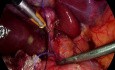 Cholécystectomie laparoscopique - comment éviter des complications