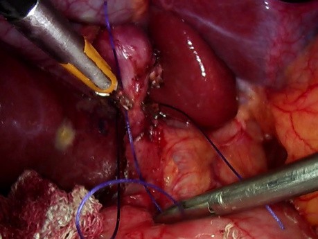 Cholécystectomie laparoscopique - comment éviter des complications