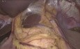 Myotomie de Heller avec Fundoplicature de Toupet
