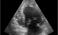 Quiz d'échocardiographie. Vue apicale. Le ventricule gauche est-il normal?