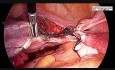 Le moyen le plus sûr d'effectuer une hystérectomie laparoscopique totale avec une salpingo-ovariectomie bilatérale