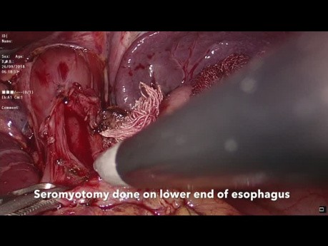 Myotomie de Heller avec fundoplication