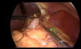 Fundoplication de Nissen laparoscopique avec renforcement hiatal
