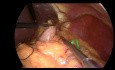 Fundoplication de Nissen laparoscopique avec renforcement hiatal