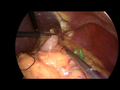 Fundoplication de Nissen laparoscopique avec renforcement hiatal