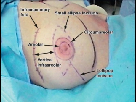 Mastectomie Simple