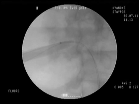 Chirurgie intrarénale rétrograde - néphrolithotomie percutanée