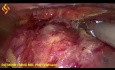 Oesophagectomie Thoraco-Laparoscopique - Partie Thoracique 1