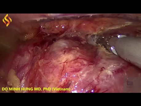 Oesophagectomie Thoraco-Laparoscopique - Partie Thoracique 1