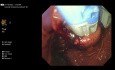 Fundoplicature transorale sans incision (TIF)