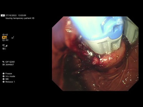 Fundoplicature transorale sans incision (TIF)