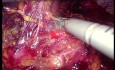 Résection Laparoscopique de Métastases Surrénaliennes