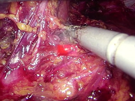 Résection Laparoscopique de Métastases Surrénaliennes