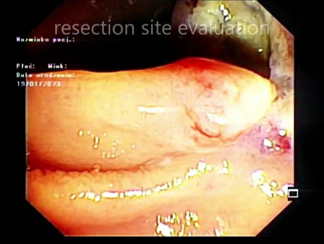 Ampullectomie (Partie1)