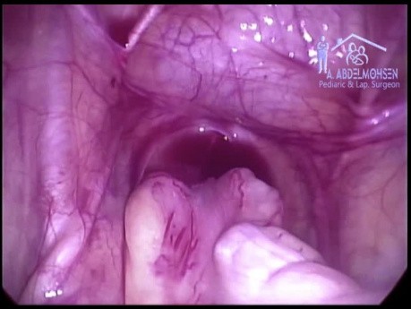 Gestion laparoscopique des testicules non descendus ; Le scénario triste