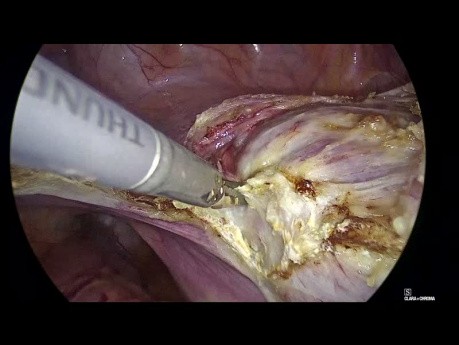 Hystérectomie laparoscopique totale - La taille compte-t-elle