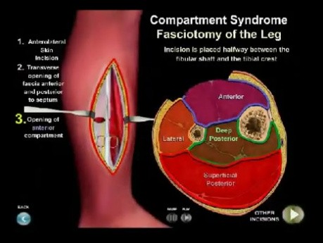 Syndrome de loge - animation