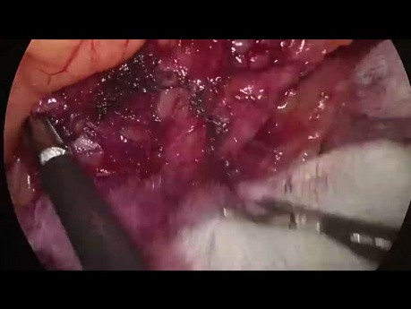 Sigmoïdectomie laparoscopique. Mobilisation de l'angle colique gauche (film complet).